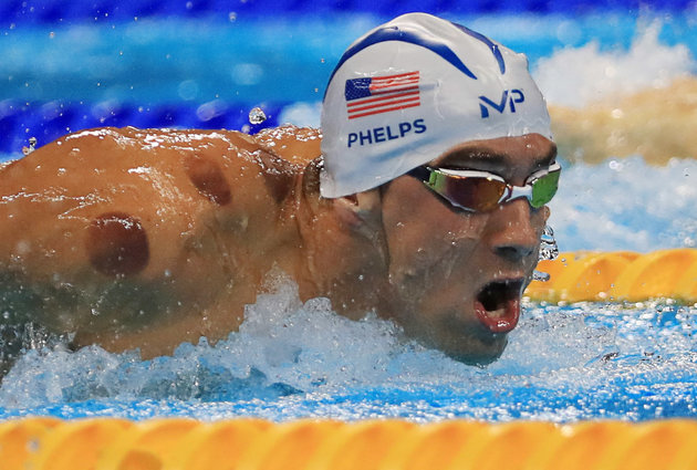 En los hombros deMichael Phelps, ganador de 23 medallas olímpicas en natación, observamos las marcas de la Hijama, cupping o ventosaterapia
